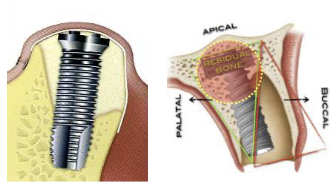 implante-alveolo