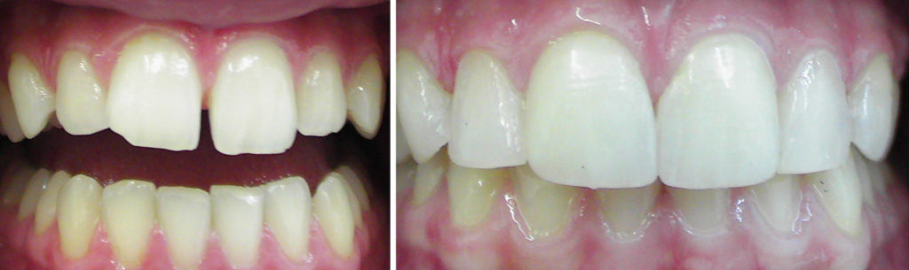 espias-alonso-clinica-cierre-diastema