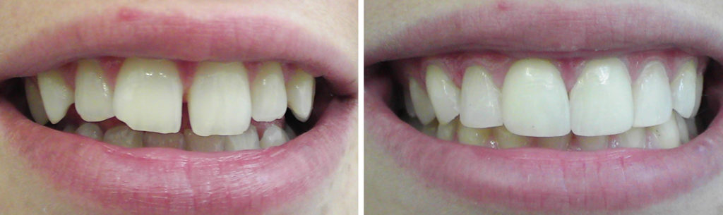 espias_alonso_clinica_diastema